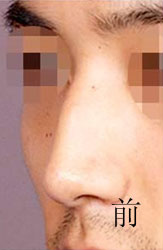 驼峰鼻矫正手术案例