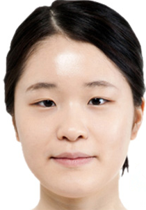 韩式无痕双眼皮案例