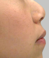 隆鼻+鼻尖整形案例
