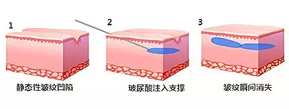 静态皱纹注射示意图