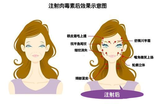 注射瘦脸除皱后效果示意图