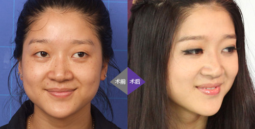 激光美白嫩肤针对性强,能够在不伤皮肤的情况下,一站式解决肌肤暗黄