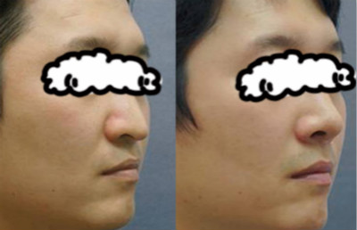 找白书成做鼻头矫正+假体隆鼻效果对比图