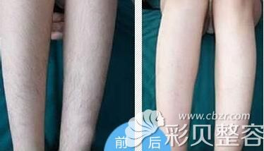 洛阳华美冰晶无痛脱毛前后对比