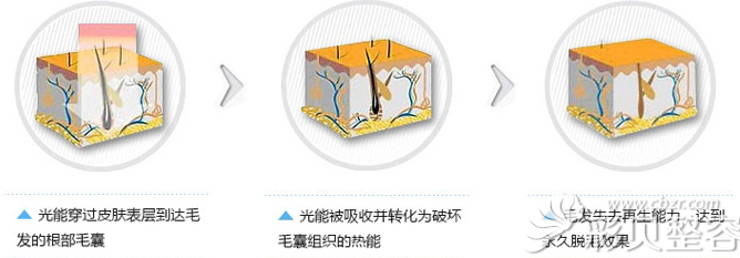 洛阳华美冰晶无痛脱毛原理