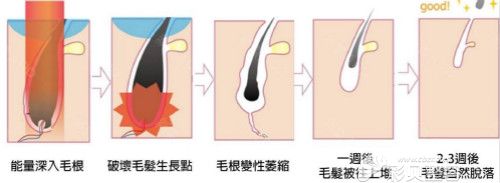 冰点脱毛示意图