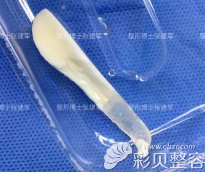 找广州博士张建军做隆鼻失败修复手术过程中取出的假体