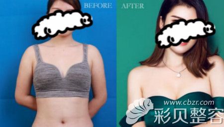 上海澳雅曼托假体隆胸真人案例效果对比