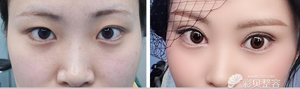 福州海峡李丽强做全切双眼皮案例