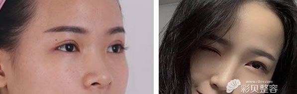 王英勇做鼻综合隆鼻效果对比图