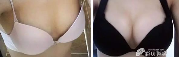 福州海峡整形的林沸腾做隆胸手术效果对比图