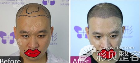 广州韩妃植发前后对比图片