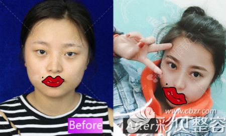 广州韩妃全切双眼皮恢复三个月对比图片