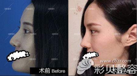 福州海峡人气项目黄金三角鼻雕真人效果案例图