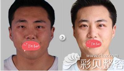 北京华韩医院技术院长李鹏超做双眼皮案例效果对比