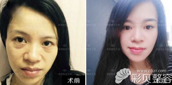 北京柏丽于波眼综合整形效果案例