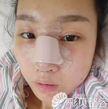 北京柏丽鼻综合隆鼻修复第三天