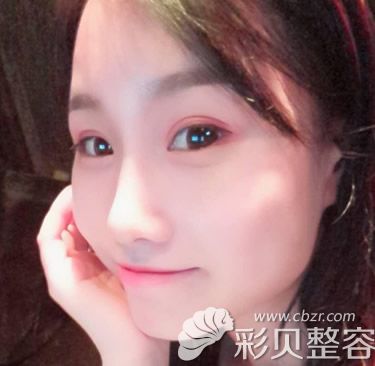 柏丽李劲良隆鼻修复一个月恢复效果