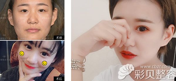 北京柏丽于波双眼皮失败修复+开眼角效果案例