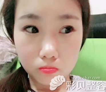 北京柏丽整形美容医院李劲良院长隆鼻失败修复前