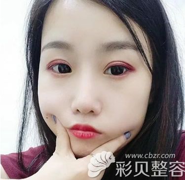 隆鼻失败修复三个月