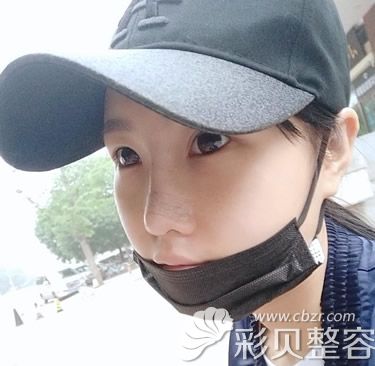 自体软骨隆鼻第七天拆线