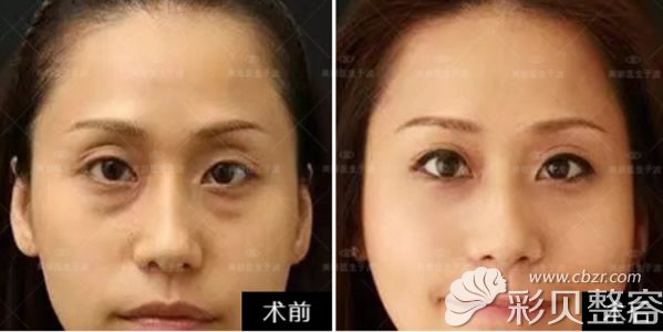 北京柏丽于波去眼袋+卧蚕三个月恢复效果