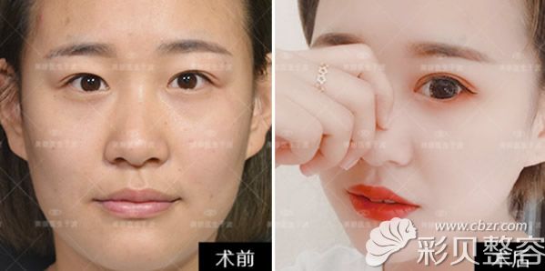 柏丽整形S线双眼皮前后效果对比