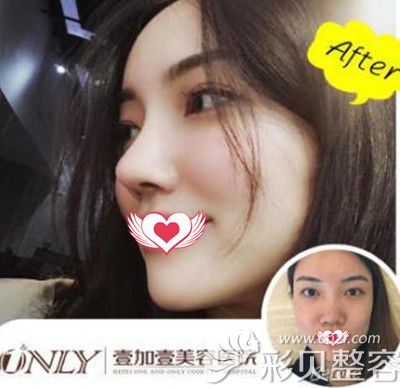 合肥壹加壹整形王大勇隆鼻案例效果