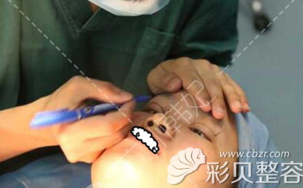 找广州韩妃于洪瑞做双眼皮前进行划线设计