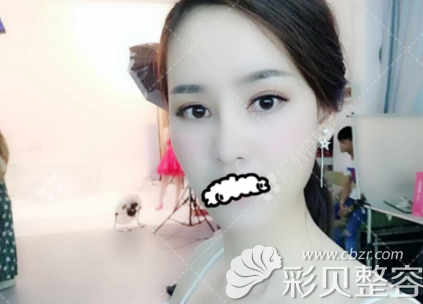 找广州韩妃于鸿儒做双眼皮术后60天效果