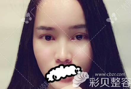 找广州韩妃于鸿儒做双眼皮术后30天效果