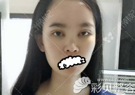 找广州韩妃于鸿儒做双眼皮术后5天效果