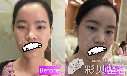 比广州韩妃和曙光哪个好后我找于洪瑞做双眼皮前样子