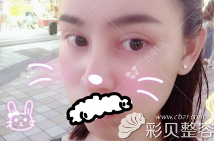 找广州韩妃于鸿儒做双眼皮术后50天效果