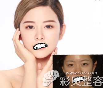 广州韩妃李光琴双眼皮+综合隆鼻案例