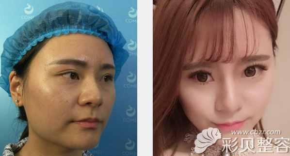 南京康美张让虎瘦脸除皱瘦脸前后效果对比