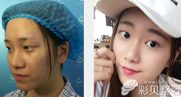 南京康美李智明全切双眼皮隆鼻效果怎么样