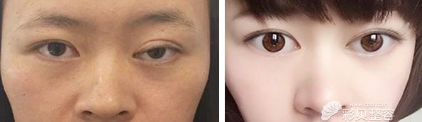 南京维多利亚焦圆华双眼皮修复案例对比图