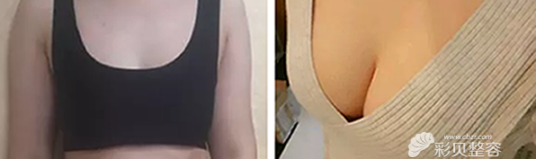 韩德昌院长做自体脂肪隆胸前后效果案例对比图