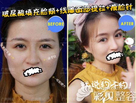 杨青青院长做的全面线雕提升+玻尿酸填充+瘦脸针案例