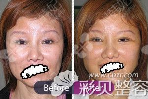 面部注射年轻化案例效果