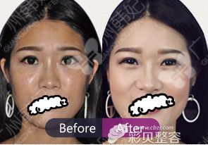 玻尿酸填充面部案例效果