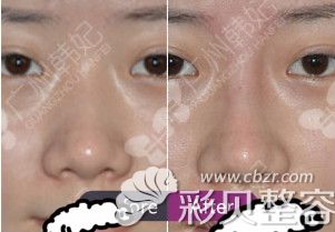 注射隆鼻案例效果