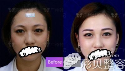广州韩妃廖明锐老师做的纹眉案例前后对比图