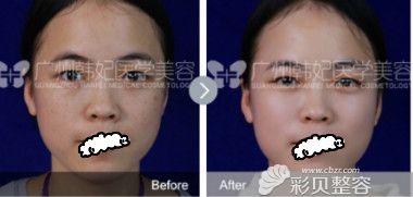 广州韩妃陈芸做的激光祛黄褐斑案例