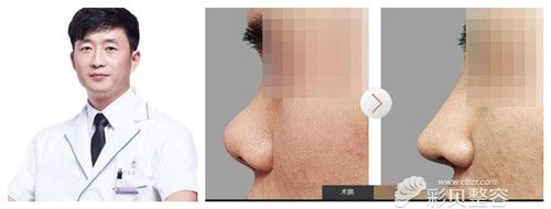 冯思阳鼻综合整形案例效果对比