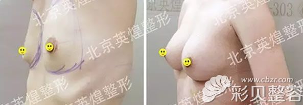 梁耀婵医生做自体脂肪隆胸一个月后的效果对比图
