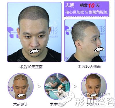 发友找广州韩妃赵进做无痕植发效果恢复过程图