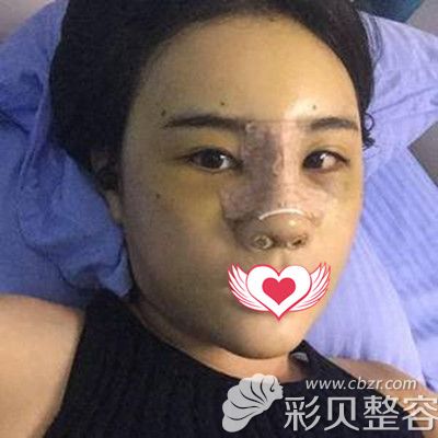 耳软骨隆鼻+脂肪填充面部术后1周效果图